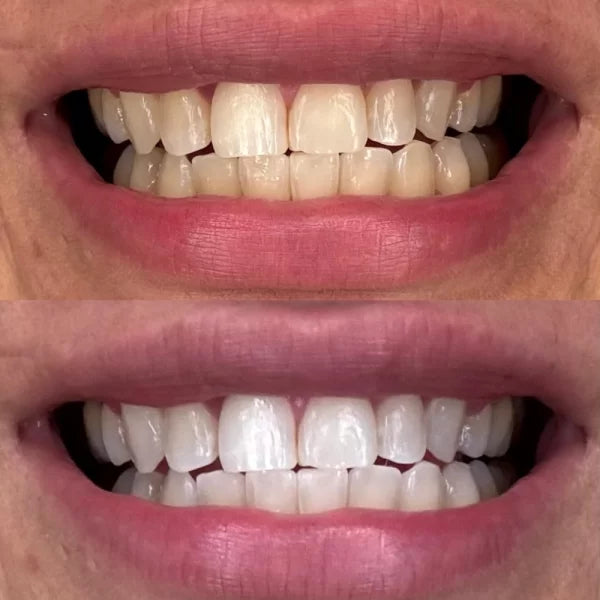 Crest 3D Whitestrips Professional Effects – Zahnaufhellung