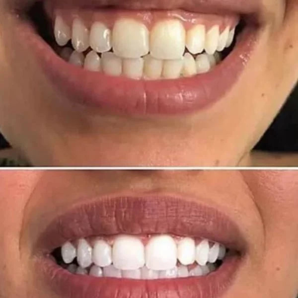 Crest 3D Whitestrips Professional Effects – Zahnaufhellung
